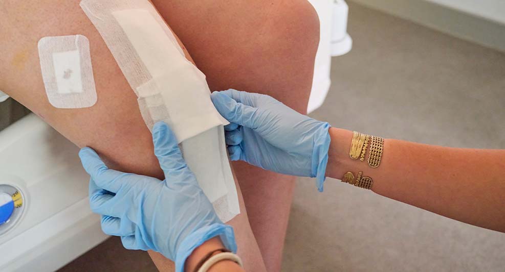 Le traitement des plaies par pression négative (TPN) : une solution innovante pour améliorer la cicatrisation et la qualité de vie